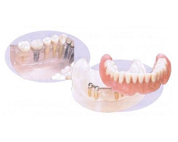 インプラントアタッチメント義歯