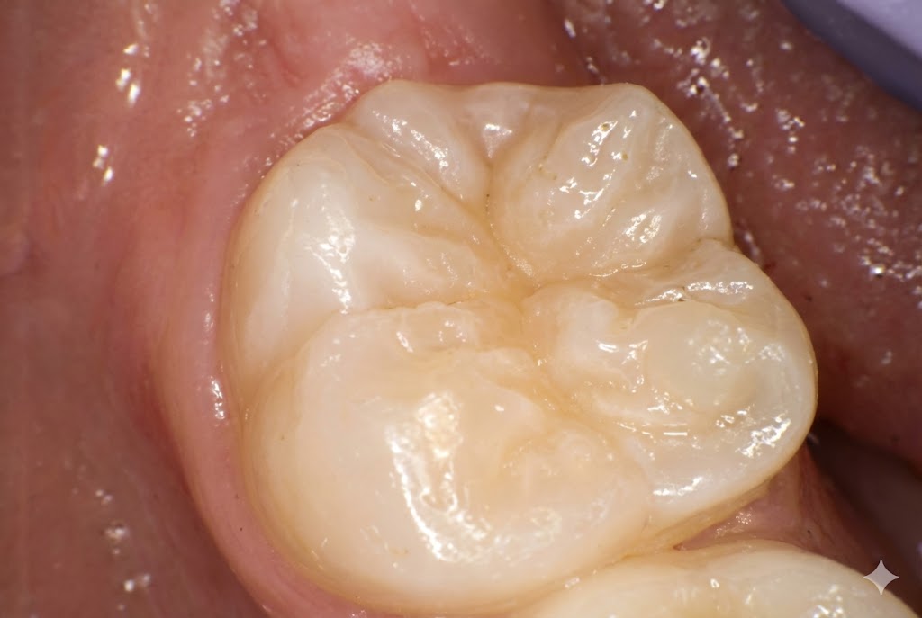シーラント処置前のイメージ