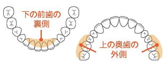 歯石ができる原因
