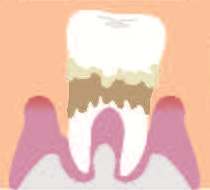 歯周炎重度