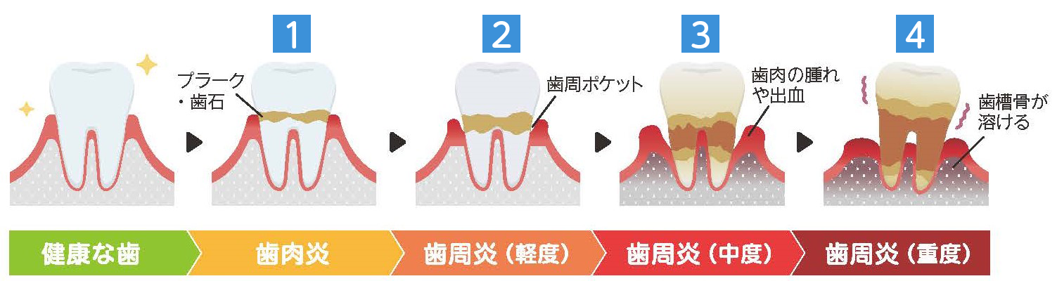 歯周病の進行プロセス