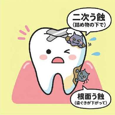 大人むし歯の2つの特徴のイラスト