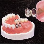 アタッチメント義歯