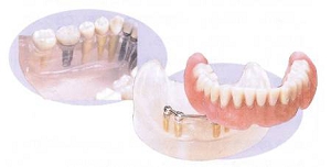 インプラント併用義歯
