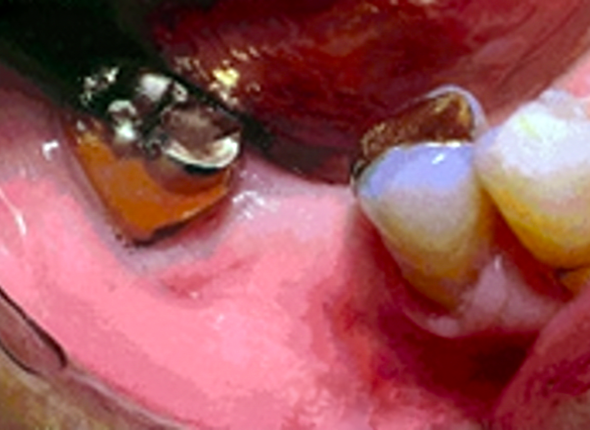 ホワイトニング術前