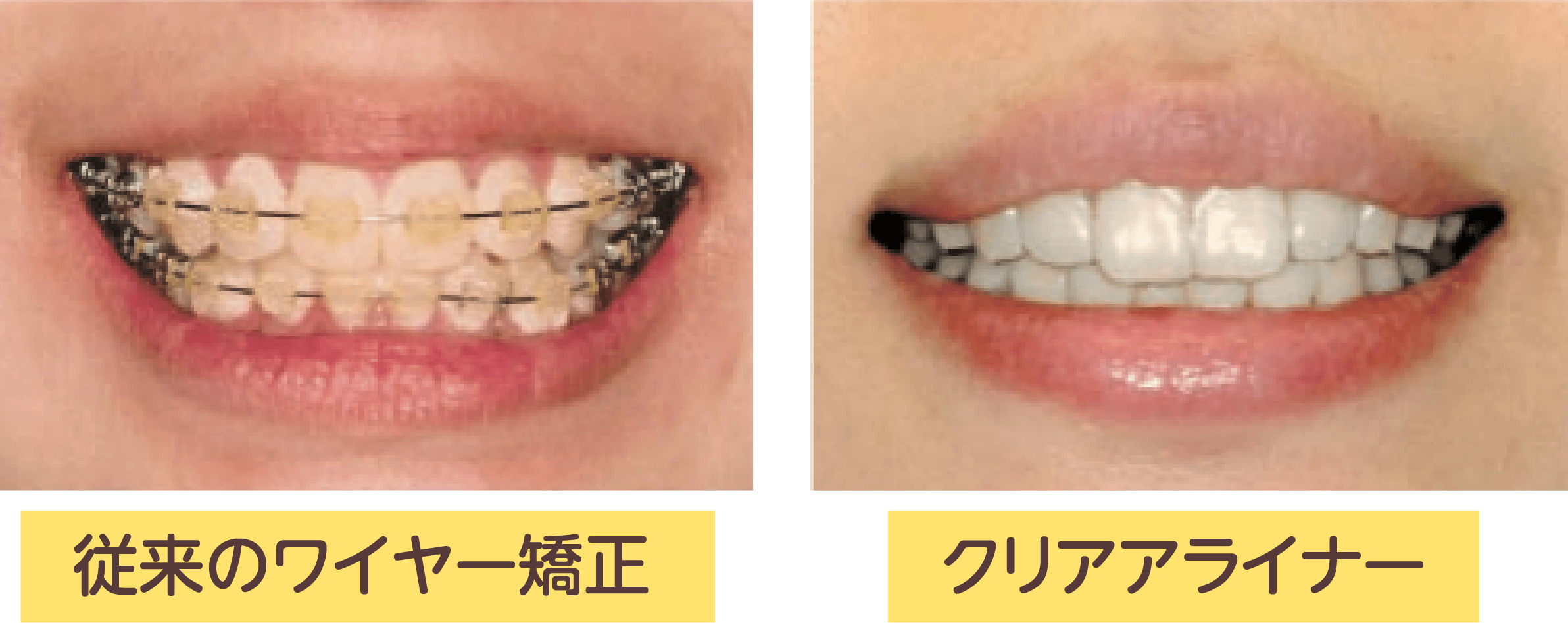 従来の矯正とクリアアライナーの比較のイメージ