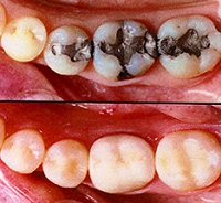 オールハイブリッドセラミック