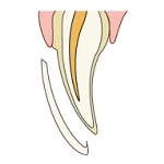 ラミネートべニア術中