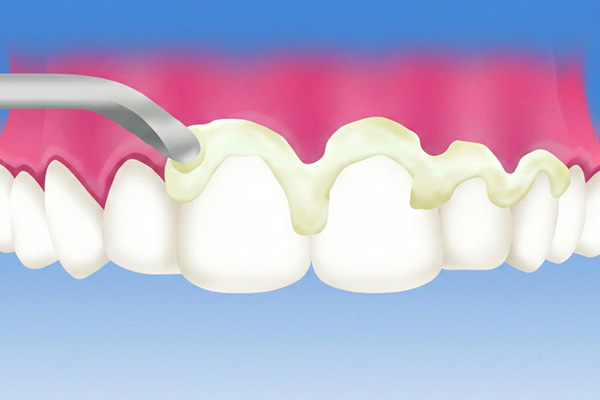 ペースト塗布のイメージ