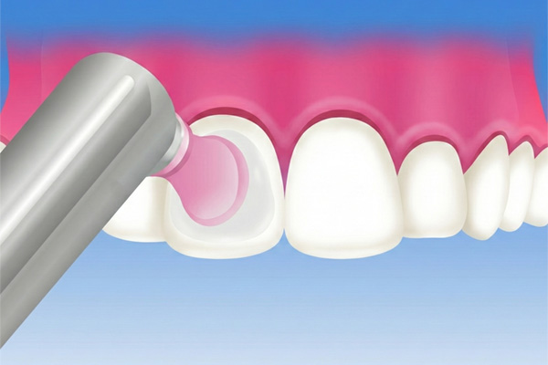 歯の表面のツヤ出しのイメージ