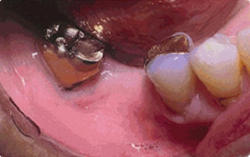 インプラント治療前