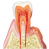 C0 歯周病とはのイメージ
