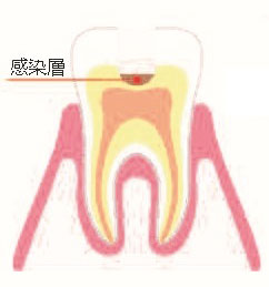 MI治療のイラスト1