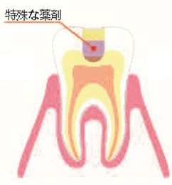 MI治療のイラスト2