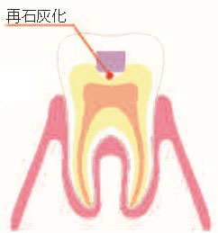 MI治療のイラスト4