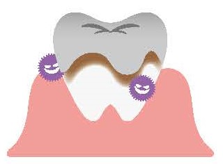 二次カリエスのイラスト