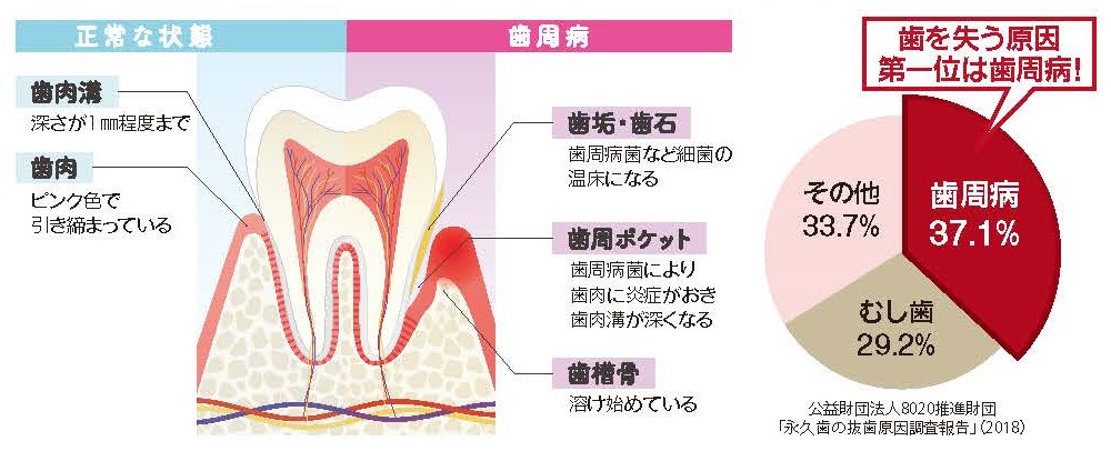 歯周病は国民病のイラスト