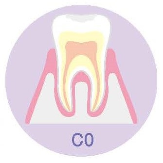 初期むし歯のイラスト