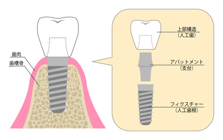 インプラント併用義歯
