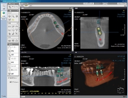 インプラントシミュレーション