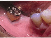 インプラント術前