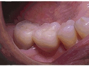 インプラント術後