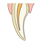 ラミネートべニア術前