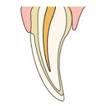 ラミネートべニア術後