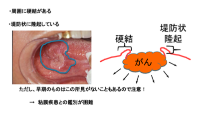 がん性潰瘍の特徴
