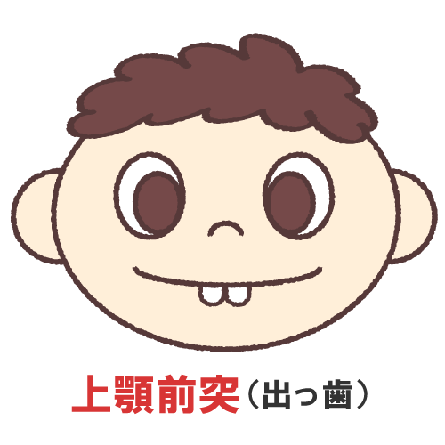 上顎前突(出っ歯)の画像