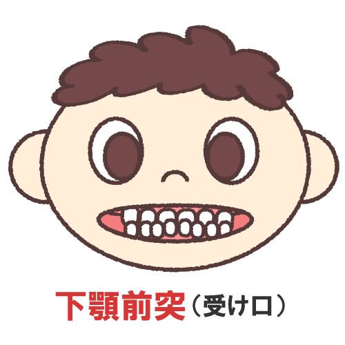 下顎前突(受け口)の画像