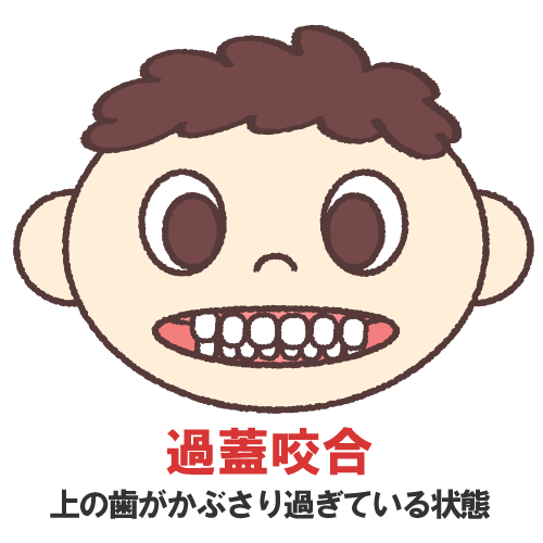 過蓋咬合のイラスト画像