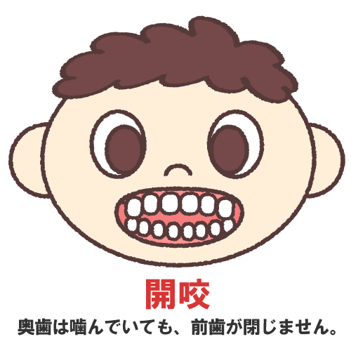 開咬のイラスト画像