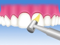 2.歯と歯の隙間清掃