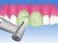 3.歯の表面のクリーニング