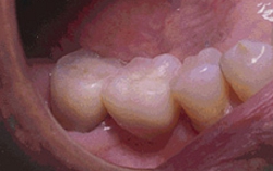 インプラント術後