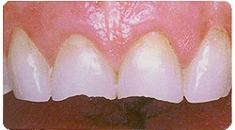 ラミネートべニア術前