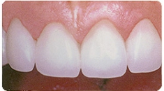 ラミネートべニア術後