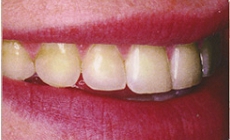 ホワイトニング術前