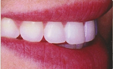 ホワイトニング術後